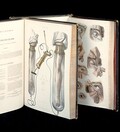 Glass tubes and accompanying pumps. Eye surgery