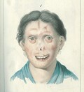 Illustration of a woman with facial lesions