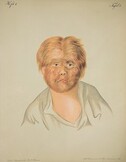 Hairy-faced boy