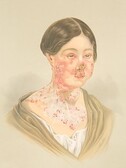 Woman with advanced lupus vulgaris