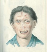 Illustration of a woman with facial lesions