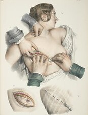 Mastectomy