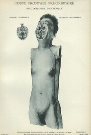 Coupe frontale preÌ-orbitaire, segment anterieÌur, segment posteÌrieur