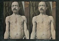 Sarcomatosis cutis