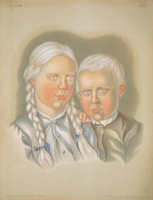 Albino children