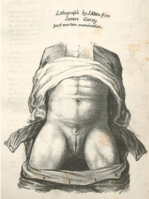 Lithograph by J. Akin from James Carey, post mortem examination