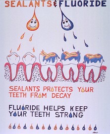 Sealants & fluoride