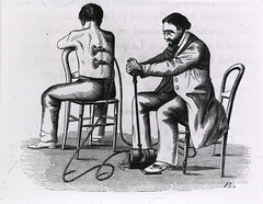 Bloodletting: Patient being cupped by physician with a terabdelle